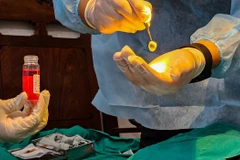 La greffe de cornée (kératoplastie) est une chirurgie oculaire cruciale remplaçant un tissu cornéen opaque ou endommagé par une greffe saine provenant d'un donneur décédé. Photo: tuoitre.vn