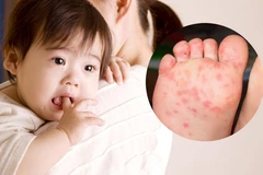 Le syndrome pieds-mains-bouche est une pathologie virale qui se caractérise par une éruption vésiculeuse sur les mains, les pieds et la muqueuse orale. Elle touche principalement les jeunes enfants, mais peut atteindre des adultes avec une présentation plus atypique. Photo : suckhoedoisong.vn