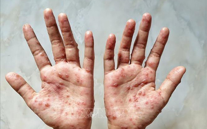 Le ministère de la Santé recommande des mesures préventives contre la variole du singe ảnh 1 Le ministère de la Santé recommande des mesures préventives contre la variole du singe ảnh 1
