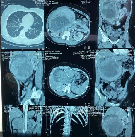 Intervention chirurgicale réussie sur une tumeur pancréatique "géante" ảnh 1 Intervention chirurgicale réussie sur une tumeur pancréatique "géante" ảnh 1