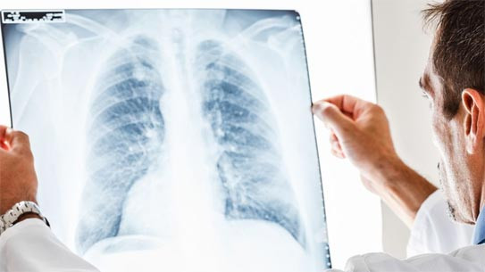 Lancement du projet Zero Tuberculosis Vietnam (ZTV) ảnh 1 Lancement du projet Zero Tuberculosis Vietnam (ZTV) ảnh 1