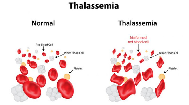 Sensibiliser davantage les gens sur la thalassémie ảnh 1 Sensibiliser davantage les gens sur la thalassémie ảnh 1