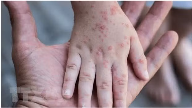 Le Vietnam doit se préparer à faire face à la variole du singe ảnh 1