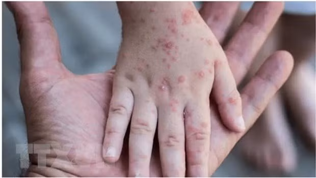Variole du singe : l’OMS continue de partager des informations avec le Vietnam ảnh 2