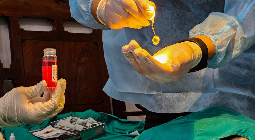 La greffe de cornée (kératoplastie) est une chirurgie oculaire cruciale remplaçant un tissu cornéen opaque ou endommagé par une greffe saine provenant d'un donneur décédé. Photo: tuoitre.vn