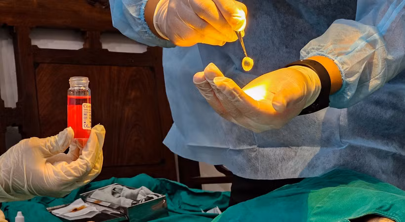 La greffe de cornée (kératoplastie) est une chirurgie oculaire cruciale remplaçant un tissu cornéen opaque ou endommagé par une greffe saine provenant d'un donneur décédé. Photo: tuoitre.vn