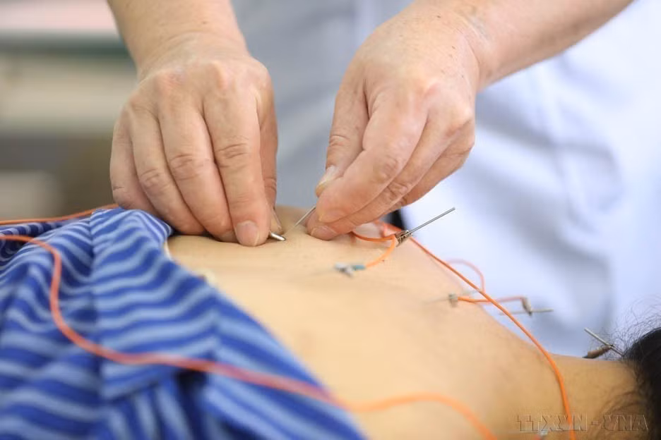 . Utilisation de l’électroacupuncture à l’hôpital provincial de médecine traditionnelle de Lang Son. Photo : VNA