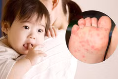 Le syndrome pieds-mains-bouche est une pathologie virale qui se caractérise par une éruption vésiculeuse sur les mains, les pieds et la muqueuse orale. Elle touche principalement les jeunes enfants, mais peut atteindre des adultes avec une présentation plus atypique. Photo : suckhoedoisong.vn