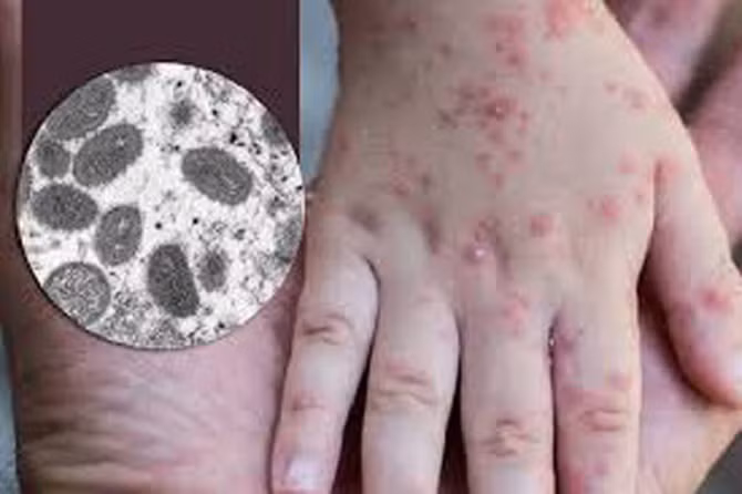 Le Vietnam a maîtrisé son premier cas de monkeypox ảnh 1 Le Vietnam a maîtrisé son premier cas de monkeypox ảnh 1