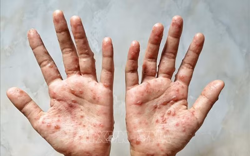 Le ministère de la Santé recommande des mesures préventives contre la variole du singe ảnh 1 Le ministère de la Santé recommande des mesures préventives contre la variole du singe ảnh 1