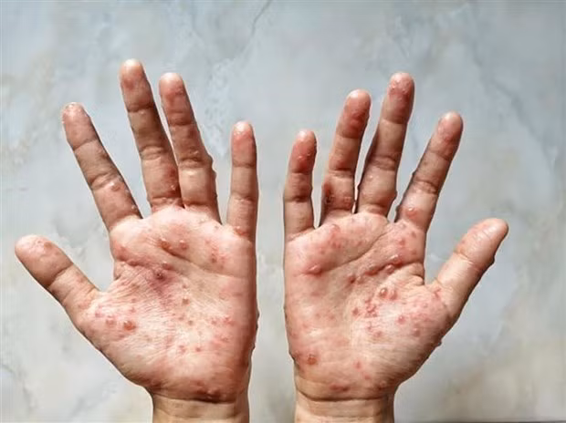 Le ministère indonésien de la Santé rassure les habitants sur la variole du singe ảnh 1 Le ministère indonésien de la Santé rassure les habitants sur la variole du singe ảnh 1