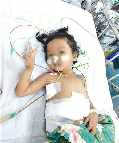 Huit jours après la greffe, l’enfant a pu manger par voie orale sans soutien et se rétablit progressivement. Photo : VNA 1.jpg