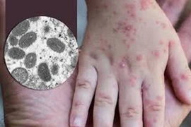 Le Vietnam a maîtrisé son premier cas de monkeypox