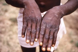 Le ministère vietnamien de la Santé publie un guide de surveillance de l'éruption du monkeypox