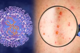 Un nouveau cas de variole du singe enregistré à Ho Chi Minh-Ville