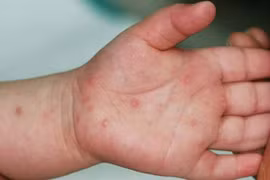 Les hôpitaux s’approvisionnent en médicaments contre la HFMD