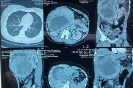 Intervention chirurgicale réussie sur une tumeur pancréatique "géante"