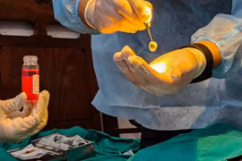 La greffe de cornée (kératoplastie) est une chirurgie oculaire cruciale remplaçant un tissu cornéen opaque ou endommagé par une greffe saine provenant d'un donneur décédé. Photo: tuoitre.vn