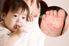 Le syndrome pieds-mains-bouche est une pathologie virale qui se caractérise par une éruption vésiculeuse sur les mains, les pieds et la muqueuse orale. Elle touche principalement les jeunes enfants, mais peut atteindre des adultes avec une présentation plus atypique. Photo : suckhoedoisong.vn