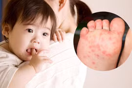 Le syndrome pieds-mains-bouche est une pathologie virale qui se caractérise par une éruption vésiculeuse sur les mains, les pieds et la muqueuse orale. Elle touche principalement les jeunes enfants, mais peut atteindre des adultes avec une présentation plus atypique. Photo : suckhoedoisong.vn